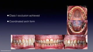 Treatment planning of surgical orthodontic cases dgkfo | PDF