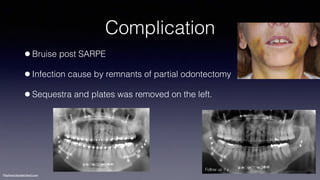 Treatment planning of surgical orthodontic cases dgkfo | PDF