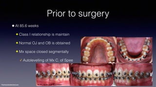 Treatment planning of surgical orthodontic cases dgkfo | PDF