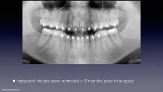 Treatment planning of surgical orthodontic cases dgkfo | PDF
