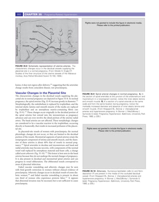 660        CHAPTER 35                Pregnancy-Related Hypertension




                                 Spinal
Endometrium




                           Basal


                        Radial


              Arcuate
Myometrium




                                                                                 A




FIGURE 35-8 Schematic representation of uterine arteries. The
characteristic changes occur in the decidual vessels supplying the
placental site in a normal pregnancy. (From Okkels H, Engle ET:
Studies of the ﬁner structure of the uterine vessels of the Macacus
monkey. Acta Pathol Microbiol Scand 15:150, 1938.)



lesion, it does not regress after delivery,103 suggesting that the arteriolar
change results from coincident disease, not preeclampsia.
                                                                                 B
Vascular Changes in the Placental Site                                          FIGURE 35-9 Spiral arterial changes in normal pregnancy. A, In
The characteristic changes in the decidual vessels supplying the pla-           the section of spiral arterioles at the junction of the endometrium and
cental site in normal pregnancy are depicted in Figure 35-8. In normal          myometrium in a nonpregnant woman, notice the inner elastic lamina
pregnancy, the spiral arteries (Fig. 35-9) increase greatly in diameter.132     and smooth muscle. B, In a section of a spiral arteriole at the same
Morphologically, the endothelium is replaced by trophoblast, and the            scale and from the same location during pregnancy, notice the
internal elastic lamina and smooth muscle of the media are replaced             markedly increased diameter and absence of inner elastic lamina and
by trophoblast and an amorphous matrix-containing ﬁbrin (see                    smooth muscle. (From Sheppard BL, Bonnar J: Uteroplacental
Fig. 35-9).133 These changes occur originally in the decidual portion of        arteries and hypertensive pregnancy. In Bonnar J, MacGillivray I,
                                                                                Symonds G [eds]: Pregnancy Hypertension. Baltimore, University Park
the spiral arteries but extend into the myometrium as pregnancy
                                                                                Press, 1980, p 205.)
advances and can even involve the distal portion of the uterine radial
artery. The basal arteries are not affected. These morphologic changes
are considered to be a vascular reaction to the trophoblast, occurring
directly or humorally, that results in increased perfusion of the placen-
tal site.
    In placental-site vessels of women with preeclampsia, the normal
physiologic changes do not occur, or they are limited to the decidual
portion of the vessels. Myometrial segments of spiral arteries retain the
nonpregnant component of intima and smooth muscle, and the diam-
eter of these arteries is about 40% that of vessels in normal preg-
nancy.134 Spiral arterioles in decidua and myometrium and basal and                                                                     F
radial arterioles may become necrotic, with components of the normal
vessel wall replaced by amorphous material and foam cells, a change
called acute atherosis (Fig. 35-10).135 This lesion is best seen in the basal
arteries because they do not undergo the normal changes of pregnancy.
It is also present in decidual and myometrial spiral arteries and can
progress to vessel obliteration. The obliterated vessels correspond to
areas of placental infarction.
    Failed vascular remodeling and atherotic changes may be seen
with fetal growth restriction in women without clinical evidence of
                                                                                FIGURE 35-10 Atherosis. Numerous lipid-laden cells (L) and ﬁbrin
preeclampsia. Atherotic changes occur in decidual vessels of some dia-          deposition (F) are present in the media of this occluded decidual
betic women,136 and failed vascular remodeling is present in about              vessel. (From Sheppard BL, Bonnar J: Uteroplacental arteries and
one third of women who experience preterm labor.137 It appears                  hypertensive pregnancy. In Bonnar J, MacGillivray I, Symonds G
that abnormal invasion may be necessary but is not sufﬁcient to cause           [eds]: Pregnancy Hypertension. Baltimore, University Park Press,
preeclampsia.                                                                   1980, p 205.)
 