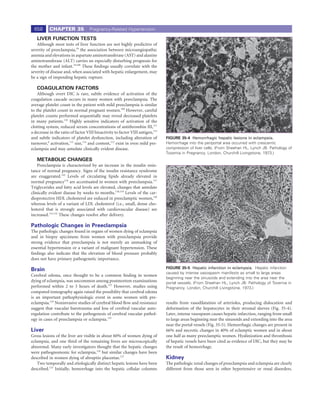 658      CHAPTER 35              Pregnancy-Related Hypertension

   LIVER FUNCTION TESTS
   Although most tests of liver function are not highly predictive of
severity of preeclampsia,18 the association between microangiopathic
anemia and elevations in aspartate aminotransferase (AST) and alanine
aminotransferase (ALT) carries an especially disturbing prognosis for
the mother and infant.19,108 These ﬁndings usually correlate with the
severity of disease and, when associated with hepatic enlargement, may
be a sign of impending hepatic rupture.

   COAGULATION FACTORS
    Although overt DIC is rare, subtle evidence of activation of the
coagulation cascade occurs in many women with preeclampsia. The
average platelet count in the patient with mild preeclampsia is similar
to the platelet count in normal pregnant women.109 However, careful
platelet counts performed sequentially may reveal decreased platelets
in many patients.110 Highly sensitive indicators of activation of the
clotting system, reduced serum concentrations of antithrombin III,111
a decrease in the ratio of factor VIII bioactivity to factor VIII antigen,112
and subtle indicators of platelet dysfunction, including alteration of          FIGURE 35-4 Hemorrhagic hepatic lesions in eclampsia.
turnover,6 activation,113 size,114 and content,115 exist in even mild pre-      Hemorrhage into the periportal area occurred with crescentic
eclampsia and may antedate clinically evident disease.                          compression of liver cells. (From Sheehan HL, Lynch JB: Pathology of
                                                                                Toxemia in Pregnancy. London, Churchill Livingstone, 1973.)
   METABOLIC CHANGES
    Preeclampsia is characterized by an increase in the insulin resis-
tance of normal pregnancy. Signs of the insulin resistance syndrome
are exaggerated.110 Levels of circulating lipids already elevated in
normal pregnancy116 are accentuated in women with preeclampsia.117
Triglycerides and fatty acid levels are elevated, changes that antedate
clinically evident disease by weeks to months.118,119 Levels of the car-
dioprotective HDL cholesterol are reduced in preeclamptic women,120
whereas levels of a variant of LDL cholesterol (i.e., small, dense cho-
lesterol that is strongly associated with cardiovascular disease) are
increased.121,122 These changes resolve after delivery.

Pathologic Changes in Preeclampsia
The pathologic changes found in organs of women dying of eclampsia
and in biopsy specimens from women with preeclampsia provide
strong evidence that preeclampsia is not merely an unmasking of
essential hypertension or a variant of malignant hypertension. These
ﬁndings also indicate that the elevation of blood pressure probably
does not have primary pathogenetic importance.

Brain                                                                           FIGURE 35-5 Hepatic infarction in eclampsia. Hepatic infarction
                                                                                caused by intense vasospasm manifests as small to large areas
Cerebral edema, once thought to be a common ﬁnding in women
                                                                                beginning near the sinusoids and extending into the area near the
dying of eclampsia, was uncommon among postmortem examinations                  portal vessels. (From Sheehan HL, Lynch JB: Pathology of Toxemia in
performed within 2 to 3 hours of death.123 However, studies using               Pregnancy. London, Churchill Livingstone, 1973.)
computed tomography again raised the possibility that cerebral edema
is an important pathophysiologic event in some women with pre-
eclampsia.124 Noninvasive studies of cerebral blood ﬂow and resistance          results from vasodilatation of arterioles, producing dislocation and
suggest that vascular barotrauma and loss of cerebral vascular auto-            deformation of the hepatocytes in their stromal sleeves (Fig. 35-4).
regulation contribute to the pathogenesis of cerebral vascular pathol-          Later, intense vasospasm causes hepatic infarction, ranging from small
ogy in cases of preeclampsia or eclampsia.125                                   to large areas beginning near the sinusoids and extending into the area
                                                                                near the portal vessels (Fig. 35-5). Hemorrhagic changes are present in
Liver                                                                           66% and necrotic changes in 40% of eclamptic women and in about
Gross lesions of the liver are visible in about 60% of women dying of           one half as many preeclamptic women. Hyalinization and thrombosis
eclampsia, and one third of the remaining livers are microscopically            of hepatic vessels have been cited as evidence of DIC, but they may be
abnormal. Many early investigators thought that the hepatic changes             the result of hemorrhage.
were pathognomonic for eclampsia,126 but similar changes have been
described in women dying of abruptio placentae.127                              Kidney
    Two temporally and etiologically distinct hepatic lesions have been         The pathologic renal changes of preeclampsia and eclampsia are clearly
described.123 Initially, hemorrhage into the hepatic cellular columns           different from those seen in other hypertensive or renal disorders.
 