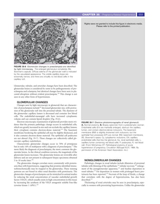 CHAPTER 35             Pregnancy-Related Hypertension            659




                                                                                            EN



                                                                                                   BM




                                                                                R



FIGURE 35-6 Glomerular changes in preeclampsia are identiﬁed                A
by light microscopy. The enlarged glomerulus completely ﬁlls
Bowman’s capsule. Diffuse edema of the glomerular wall is indicated                  Ep                      Cy
by the vacuolated appearance. The visible capillary loops are
extremely narrow, and there are virtually no red blood cells in the
capillary tuft.
                                                                                                                                              En

Glomerular, tubular, and arteriolar changes have been described. The
glomerular lesion is considered by some to be pathognomonic of pre-
eclampsia and eclampsia, but identical changes have been seen in pla-       BS                     R
cental abruption without evident preeclampsia.128 This change is not
                                                                                                                                                En
seen in any other form of hypertension.
                                                                                    Ep
   GLOMERULAR CHANGES
    Changes seen by light microscopy in glomeruli that are character-
istic of preeclampsia include103 decreased glomerular size, with protru-
sion of the glomerular tuft into the proximal tubule. The diameter of                                   P
the glomerular capillary lumen is decreased and contains few blood
cells. The endothelial-mesangial cells have increased cytoplasmic
                                                                            B
volume and can contain lipoid droplets (Fig. 35-6).
    Electron microscopic examination of glomeruli provides more evi-       FIGURE 35-7 Electron photomicrographs of renal glomeruli.
dence that the primary pathologic change occurs in endothelial cells,      A, Normal anatomy. B, Biopsy specimen from a preeclamptic woman.
which are greatly increased in size and can occlude the capillary lumen;   Endothelial cells (En) are markedly enlarged, obstruct the capillary
their cytoplasm contains electron-dense material.129 The basement          lumen, and contain electron-dense inclusions. The basement
membrane bordering the epithelial cell may be slightly thickened, and      membrane (BM) is slightly thickened with inclusions, but the
it also contains electron-dense material. The epithelial cell podocytes    epithelial foot processes (EP) are normal. BM, basement membrane;
are not altered (Fig. 35-7). These changes are collectively called glo-    BS, Bowman’s space; Cy, cytoplasmic inclusions; EN, capillary
                                                                           endothelial cells that line the glomeruli; Ep, renal epithelial cells; L,
merular capillary endotheliosis.
                                                                           capillary lumen containing red blood cells; P, podocytes; R, red blood
    Characteristic glomerular changes occur in 70% of primiparas
                                                                           cell. (From McCartney CP: Pathological anatomy of acute
but in only 14% of multiparas with a diagnosis of preeclampsia.17 The      hypertension of pregnancy. Circulation 30[Suppl II]:37, 1964. By
more likely the diagnosis of preeclampsia, the more common the glo-        permission of the American Heart Association, Inc.)
merular lesion. As the clinical condition worsens, the magnitude of the
glomerular lesion increases. The glomerular lesions are reversible after
delivery and are not present in subsequent biopsy specimens obtained
5 to 10 weeks later.103                                                       NONGLOMERULAR CHANGES
    The glomerular changes correlate more consistently with protein-           Pathologic changes in renal tubules include dilatation of proximal
uria than with hypertension, suggesting that proteins identiﬁed immu-      tubules with thinning of the epithelium,123 tubular necrosis,103 enlarge-
nohistochemically may be trapped in the glomerulus. These staining         ment of the juxtaglomerular apparatus,131 and hyaline deposition in
patterns are not found in other renal disorders with proteinuria. The      renal tubules.123 Fat deposition in women with prolonged heavy pro-
glomerular changes of preeclampsia can be mimicked in animal studies       teinuria has been reported.123 Necrosis of the loop of Henle, a change
by reducing the renal concentration of vascular endothelial growth         that correlates with the degree of hyperuricemia, has also been
factor (VEGF), which usually exists in high concentration in this tissue   described.131
by increasing the synthesis of the VEGF antagonist soluble Fms-like            Thickening of renal arterioles may be seen in preeclampsia, espe-
tyrosine kinase 1 (sFlt1).130                                              cially in women with preexisting hypertension. Unlike the glomerular
 