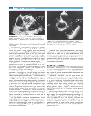 806       CHAPTER 39             Cardiac Diseases


                                 LA




                                      AV
                                                                                                                                  PA




                                             RVOT


                                                                                                                    RV


FIGURE 39-5 Transesophageal echocardiographic image of a
bicuspid aortic valve. During systole, only two aortic valve (AV)
leaﬂets are seen. LA, left atrium; RVOT, right ventricular outﬂow tract.
                                                                              FIGURE 39-6 Transesophageal echocardiographic image of
                                                                              pulmonic stenosis. The pulmonic valve leaﬂets exhibit characteristic
that limits the ability of the heart to respond to demands for increased      doming (arrow). PA, pulmonary artery; RV, right ventricle.
cardiac output.
    In the syndrome of severe congenital aortic stenosis, the pulses are
of slow upstroke and diminished amplitude. Unlike adults with
acquired aortic stenosis, children and young adults with congenital               Vasodilators, helpful in patients with heart failure of other etiology,
aortic stenosis have an abnormally loud aortic valve closure sound. Left      are dangerous in patients with aortic stenosis, because the impeded left
ventricular ejection is prolonged, so that the aortic valve closure sound     ventricle may not be able to ﬁll the dilated peripheral vascular bed. It
may occur after the pulmonary valve closure sound. Therefore, split-          should be remembered that the lowered systemic vascular resistance
ting of the second heart sound is paradoxical and is heard in expiration      of pregnancy adversely affects aortic stenosis. The obstructed left ven-
instead of inspiration. Often a loud ejection sound is heard in early         tricle is limited in its ability to ﬁll the dilated peripheral bed, a situation
systole. The duration of the ejection murmur and the time to its peak         that can lead to syncope or more serious manifestations of limited,
intensity increase with worsening severity of aortic stenosis.                relatively ﬁxed cardiac output.
    The ECG shows severe left ventricular hypertrophy. The chest
radiograph is characterized by poststenotic dilatation of the aorta.
Although some patients complain of dyspnea, chest pain, and syncope,          Pulmonic Stenosis
others remain asymptomatic. The lesion can be recognized and its              The murmur of pulmonic stenosis is loud and is often accompanied
severity assessed by Doppler echocardiography.                                by a thrill. The lesion is usually detected in early childhood and is likely
    Critical calciﬁc aortic stenosis is usually treated by aortic valve       to have been corrected before the childbearing age. Expectant mothers
replacement in older patients, but aortic valve repair is often possible      who have not had adequate health supervision in childhood may have
in younger women of childbearing age with congenital aortic stenosis.         unrecognized pulmonary stenosis.
If aortic stenosis is severe—and especially if it is symptomatic—the              The diagnosis is suggested by a long, harsh systolic murmur over
woman should be advised against becoming pregnant. She should be              the upper left sternal border that is usually preceded by an ejection
advised that, if the aortic valve must be replaced, pregnancy and labor       sound. The venous pressure is normal, but there are striking a waves
would be difﬁcult and dangerous because of the need for anticoagulant         in the jugular venous pulse. The pulmonary valve closure sound is
treatment after a mechanical prosthesis is implanted. Maternal mortal-        usually too soft to hear when pulmonary stenosis is severe. Severe
ity rates as high as 17% have been reported,45 although more recent           pulmonary stenosis causes massive concentric right ventricular
data have suggested a somewhat lower risk. However, these studies also        hypertrophy; this is manifested by a left parasternal heave and by tall
emphasize the adverse effects of severe maternal aortic stenosis on fetal     R waves and deeply inverted T waves in the right precordial leads of
outcomes, including increased rates of preterm delivery and intrauter-        the ECG. Tall, pointed P waves are also present, denoting right atrial
ine growth restriction.46 If aortic stenosis is moderate in severity, the     enlargement.
patient should be advised to complete her pregnancies before the aortic           Right ventricular enlargement and poststenotic dilatation of the
valve is replaced. Labor can be managed in such cases without a high          main and left pulmonary arteries are seen on the chest radiograph,
maternal or fetal risk, but assisted shortening of the second stage of        which also may show slightly diminished peripheral pulmonary vas-
labor is recommended.47                                                       culature. Echocardiography demonstrates limited opening of the pul-
    Strict limits on physical exertion and prolonged periods of bed rest      monic valve leaﬂets (Fig. 39-6), right ventricular hypertrophy, and
may be required. Left ventricular failure may appear and may necessi-         abnormally high velocity of blood ﬂow in the pulmonary artery.
tate the use of diuretic agents and digitalis. Rarely, even in the presence   Doppler echocardiography also allows calculation of the right ven-
of severe aortic stenosis, heart failure may be due to another cause (e.g.,   tricular pressure and the systolic pressure gradient across the valve.
peripartum cardiomyopathy).48 Prophylaxis against bacterial endocar-          These pressures can also be measured directly in the hemodynamics
ditis at delivery is recommended.                                             laboratory (Fig. 39-7).
 