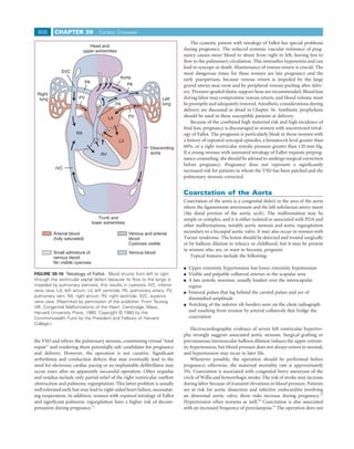 808       CHAPTER 39                 Cardiac Diseases

                                                                                  The cyanotic patient with tetralogy of Fallot has special problems
                              Head and
                           upper extremities                                  during pregnancy. The reduced systemic vascular resistance of preg-
                                                                              nancy causes more blood to shunt from right to left, leaving less to
                                                                              ﬂow to the pulmonary circulation. This intensiﬁes hypoxemia and can
                                                                              lead to syncope or death. Maintenance of venous return is crucial. The
              SVC                                                             most dangerous times for these women are late pregnancy and the
                                                  Aorta                       early puerperium, because venous return is impeded by the large
                              PA
                                                       PA                     gravid uterus near term and by peripheral venous pooling after deliv-
                                                                              ery. Pressure-graded elastic support hose are recommended. Blood loss
 Right
  lung                  PV                                             Left   during labor may compromise venous return, and blood volume must
                                                 PA                    lung   be promptly and adequately restored. Anesthetic considerations during
                                                                              delivery are discussed in detail in Chapter 56. Antibiotic prophylaxis
                                            LA         PV                     should be used in these susceptible patients at delivery.
                                                                                  Because of the combined high maternal risk and high incidence of
                                                                              fetal loss, pregnancy is discouraged in women with uncorrected tetral-
                      RA                                                      ogy of Fallot. The prognosis is particularly bleak in those women with
                                                  LV                          a history of repeated syncopal episodes, a hematocrit level greater than
                                                                 Descending   60%, or a right ventricular systolic pressure greater than 120 mm Hg.
                                       RV                        aorta        If a young woman with untreated tetralogy of Fallot requests prepreg-
                                                                              nancy counseling, she should be advised to undergo surgical correction
                                                                              before pregnancy. Pregnancy does not represent a signiﬁcantly
           IVC
                                                                              increased risk for patients in whom the VSD has been patched and the
                                                                              pulmonary stenosis corrected.


                                                                              Coarctation of the Aorta
                                                                              Coarctation of the aorta is a congenital defect in the area of the aorta
                                                                              where the ligamentum arteriosum and the left subclavian artery insert
                                                                              (the distal portion of the aortic arch). The malformation may be
                                      Trunk and                               simple or complex, and it is either isolated or associated with PDA and
                                   lower extremities
                                                                              other malformations, notably aortic stenosis and aortic regurgitation
          Arterial blood                               Venous and arterial    secondary to a bicuspid aortic valve. It may also occur in women with
          (fully saturated)                            blood                  Turner syndrome. The lesion should be detected and treated surgically
                                                       Cyanosis visible       or by balloon dilation in infancy or childhood, but it may be present
                                                                              in women who are, or want to become, pregnant.
          Small admixture of                           Venous blood
          venous blood                                                           Typical features include the following:
          No visible cyanosis
                                                                                Upper extremity hypertension but lower extremity hypotension
FIGURE 39-10 Tetralogy of Fallot. Blood shunts from left to right               Visible and palpable collateral arteries in the scapular area
through the ventricular septal defect because its ﬂow to the lungs is           A late systolic murmur, usually loudest over the interscapular
impeded by pulmonary stenosis; this results in cyanosis. IVC, inferior          region
vena cava; LA, left atrium; LV, left ventricle; PA, pulmonary artery; PV,       Femoral pulses that lag behind the carotid pulses and are of
pulmonary vein; RA, right atrium; RV, right ventricle; SVC, superior
                                                                                diminished amplitude
vena cava. (Reprinted by permission of the publisher. From Taussig
                                                                                Notching of the inferior rib borders seen on the chest radiograph
HB: Congenital Malformations of the Heart. Cambridge, Mass,
Harvard University Press, 1960. Copyright © 1960 by the                         and resulting from erosion by arterial collaterals that bridge the
Commonwealth Fund by the President and Fellows of Harvard                       coarctation
College.)
                                                                                  Electrocardiographic evidence of severe left ventricular hypertro-
                                                                              phy strongly suggests associated aortic stenosis. Surgical grafting or
the VSD and relieve the pulmonary stenosis, constituting virtual “total       percutaneous intravascular balloon dilation reduces the upper extrem-
repair” and rendering them potentially safe candidates for pregnancy          ity hypertension, but blood pressure does not always return to normal,
and delivery. However, the operation is not curative. Signiﬁcant              and hypertension may recur in later life.
arrhythmia and conduction defects that may eventually lead to the                 Whenever possible, the operation should be performed before
need for electronic cardiac pacing or an implantable deﬁbrillator may         pregnancy; otherwise, the maternal mortality rate is approximately
occur years after an apparently successful operation. Other sequelae          3%. Coarctation is associated with congenital berry aneurysm of the
and residua include only partial relief of the right ventricular outﬂow       circle of Willis and hemorrhagic stroke. The risk of stroke may increase
obstruction and pulmonic regurgitation. This latter problem is usually        during labor because of transient elevations in blood pressure. Patients
well tolerated early but may lead to right-sided heart failure, necessitat-   are at risk for aortic dissection and infective endocarditis involving
ing reoperation. In addition, women with repaired tetralogy of Fallot         an abnormal aortic valve; these risks increase during pregnancy.53
and signiﬁcant pulmonic regurgitation have a higher risk of decom-            Hypertension often worsens as well.54 Coarctation is also associated
pensation during pregnancy.52                                                 with an increased frequency of preeclampsia.31 The operation does not
 