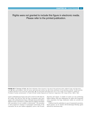 CHAPTER 39            Cardiac Diseases        809




 A                                                                           B




 C                                                                           D
FIGURE 39-11 Tetralogy of Fallot. A, Chest radiograph. Note concavity in the area of the pulmonary artery, oligemic lungs, and right aortic
arch. B, Right ventriculogram. Note the narrow right ventricular outﬂow tract. C, Further clariﬁcation of the pulmonary arteries. The left ventricle
is slightly opaciﬁed via the ventricular septal defect. D, The associated right-sided aortic arch is now visible. (From Shabetai R, Adolph RJ:
Principles of cardiac catheterization. In Fowler NO [ed]: Cardiac Diagnosis and Treatment. Hagerstown, MD: Harper & Row, 1980, p 106.)


require cardiopulmonary bypass and can be carried out with safety for        dissection and rupture. A number of centers are now performing
the mother and with less fetal risk than accompanies open heart              balloon dilation with stent implantation for adults with unoperated
surgery with cardiopulmonary bypass. Although transvascular balloon          aortic coarctation, but large, multicenter studies are currently not
dilation of aortic coarctation is a viable option for children and infants   available.56
with coarctation, its use in adults is controversial.55 The procedure            If delivery must be undertaken in cases of unoperated coarctation,
is well accepted for treatment of postsurgical renarrowing of the            blood pressure can be titrated with β-adrenergic–blocking agents
coarctation, but de novo balloon angioplasty carries a risk of aortic        delivered by intravenous drip.
 