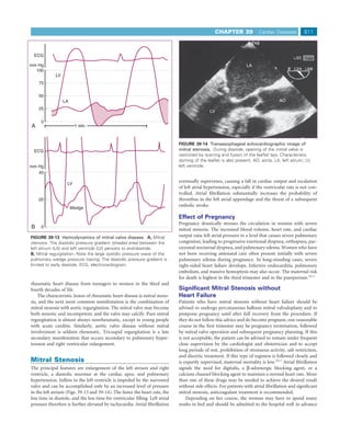 CHAPTER 39              Cardiac Diseases         811



 ECG

mm Hg                                                                                                              LA
  100
             LV
    75

    50
                  LA                                                                                                                 AO
    25
                                                                                               LV

     0
A                        1 sec.



                                                                               FIGURE 39-14 Transesophageal echocardiographic image of
 ECG                                                                           mitral stenosis. During diastole, opening of the mitral valve is
                                                                               restricted by scarring and fusion of the leaﬂet tips. Characteristic
                                                                               doming of the leaﬂet is also present. AO, aorta; LA, left atrium; LV,
mm Hg                                                                          left ventricle.
   40

                    LV
                                                                               eventually supervenes, causing a fall in cardiac output and escalation
                                                                               of left atrial hypertension, especially if the ventricular rate is not con-
                                                                               trolled. Atrial ﬁbrillation substantially increases the probability of
    20                                                                         thrombus in the left atrial appendage and the threat of a subsequent
                                                                               embolic stroke.
                       Wedge

                                                                               Effect of Pregnancy
                                                                               Pregnancy drastically stresses the circulation in women with severe
B    0
                                                                               mitral stenosis. The increased blood volume, heart rate, and cardiac
FIGURE 39-13 Hemodynamics of mitral valve disease. A, Mitral                   output raise left atrial pressure to a level that causes severe pulmonary
stenosis. The diastolic pressure gradient (shaded area) between the            congestion, leading to progressive exertional dyspnea, orthopnea, par-
left atrium (LA) and left ventricle (LV) persists to end-diastole.             oxysmal nocturnal dyspnea, and pulmonary edema. Women who have
B, Mitral regurgitation. Note the large systolic pressure wave of the          not been receiving antenatal care often present initially with severe
pulmonary wedge pressure tracing. The diastolic pressure gradient is           pulmonary edema during pregnancy. In long-standing cases, severe
limited to early diastole. ECG, electrocardiogram.                             right-sided heart failure develops. Infective endocarditis, pulmonary
                                                                               embolism, and massive hemoptysis may also occur. The maternal risk
                                                                               for death is highest in the third trimester and in the puerperium.10,11
rheumatic heart disease from teenagers to women in the third and
fourth decades of life.                                                        Signiﬁcant Mitral Stenosis without
    The characteristic lesion of rheumatic heart disease is mitral steno-      Heart Failure
sis, and the next most common manifestation is the combination of              Patients who have mitral stenosis without heart failure should be
mitral stenosis with aortic regurgitation. The mitral valve may become         advised to undergo percutaneous balloon mitral valvuloplasty and to
both stenotic and incompetent, and the valve may calcify. Pure mitral          postpone pregnancy until after full recovery from the procedure. If
regurgitation is almost always nonrheumatic, except in young people            they do not follow this advice and do become pregnant, one reasonable
with acute carditis. Similarly, aortic valve disease without mitral            course in the ﬁrst trimester may be pregnancy termination, followed
involvement is seldom rheumatic. Tricuspid regurgitation is a late             by mitral valve operation and subsequent pregnancy planning. If this
secondary manifestation that occurs secondary to pulmonary hyper-              is not acceptable, the patient can be advised to remain under frequent
tension and right ventricular enlargement.                                     close supervision by the cardiologist and obstetrician and to accept
                                                                               long periods of rest, prohibition of strenuous activity, salt restriction,
                                                                               and diuretic treatment. If this type of regimen is followed closely and
Mitral Stenosis                                                                is expertly supervised, maternal mortality is low.10,11 Atrial ﬁbrillation
The principal features are enlargement of the left atrium and right            signals the need for digitalis, a β-adrenergic blocking agent, or a
ventricle, a diastolic murmur at the cardiac apex, and pulmonary               calcium channel blocking agent to maintain a normal heart rate. More
hypertension. Inﬂow to the left ventricle is impeded by the narrowed           than one of these drugs may be needed to achieve the desired result
valve and can be accomplished only by an increased level of pressure           without side effects. For patients with atrial ﬁbrillation and signiﬁcant
in the left atrium (Figs. 39-13 and 39-14). The faster the heart rate, the     mitral stenosis, anticoagulant treatment is recommended.
less time in diastole, and the less time for ventricular ﬁlling. Left atrial       Depending on her course, the woman may have to spend many
pressure therefore is further elevated by tachycardia. Atrial ﬁbrillation      weeks in bed and should be admitted to the hospital well in advance
 