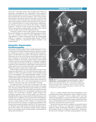 CHAPTER 39             Cardiac Diseases        815
may be less.89 The largest study to date of patients with a history of
peripartum cardiomyopathy who subsequently became pregnant90
showed that heart failure recurred in 20% of those patients whose EF
had normalized after the previous pregnancy. None of these patients
died during the study period. However, heart failure recurred in 40%
                                                                                                         LA
of the patients who had persistent left ventricular dysfunction after
their previous pregnancy, and the maternal mortality in this group was
19%. A study from Haiti of 15 women with peripartum cardiomyopa-
thy showed a recurrence rate of almost 50% during a subsequent                                                            AO
pregnancy.91 Therefore, the risk of recurrent heart failure is high in
women with peripartum cardiomyopathy, especially in those who do
not have complete recovery of left ventricular function.
   Treatment is similar to that for other patients with heart failure.
Because ACE inhibitors are contraindicated during pregnancy hydrala-                                       LV
zine is the vasodilator of choice. If cardiac dysfunction is severe,
anticoagulation is usually recommended, given the prothrombotic
tendency of pregnancy. Low-molecular-weight heparin (LMWH)
is probably preferred to unfractionated heparin (warfarin is not
recommended).86
                                                                               A
Idiopathic Hypertrophic
Cardiomyopathy
Hypertrophic cardiomyopathy, which is usually inherited as an auto-
somal dominant trait with variable penetrance but sometimes is caused
by a spontaneous mutation, is being recognized with increasing fre-                                        LA
quency. The phenotypes vary greatly. Left ventricular outﬂow tract
obstruction may or may not be present, and the hypertrophy may be
either symmetrical or asymmetrical. The chief symptoms are angina,                                                           AO
dyspnea, arrhythmia, and syncope. Sudden death is a feature mostly
conﬁned to patients in whom the diagnosis is established in childhood
or youth, patients with a history of syncope or ventricular arrhythmia,
and patients with a family history of hypertrophic cardiomyopathy and
sudden death. Recent research has shown that certain speciﬁc genetic                                          LV
defects place patients at great risk for sudden death.
    When the disease is ﬁrst detected in older adults, the course is more
benign and sudden death is rare. Left ventricular hypertrophy is often
apparent on clinical examination and ECG and is invariably present
on the echocardiogram. The echocardiographic ﬁndings are often
diagnostic and include marked thickening of the ventricular septum,
usually with less thickness of the other walls of the left ventricle (asym-    B
metrical hypertrophy), and abnormal systolic anterior movement of             FIGURE 39-17 Transesophageal echocardiographic images of
the mitral valve (Fig. 39-17). The internal dimensions of the left            hypertrophic cardiomyopathy. A, During diastole the anterior
ventricle are normal to small, and its contractility is increased.            leaﬂet of the mitral valve (arrow) is in a normal position. B, During
    An important feature in many cases is obstruction of the space            systole the leaﬂet (arrow) is pulled by Venturi forces into the left
between the ventricular septum and the anterior leaﬂet of the mitral          ventricular outﬂow tract, causing obstruction to outﬂow. AO, aorta;
valve. This space constitutes the left ventricular outﬂow tract. Outﬂow       LA, left atrium; LV, left ventricle.
obstruction by the anterior mitral valve leaﬂet is worsened by increased
inotropy, decreased heart size, and diminished peripheral vascular
resistance. The normal fall in peripheral vascular resistance that               There is a complex interplay between the hemodynamics of the
accompanies pregnancy tends to increase outﬂow tract obstruction,             cardiomyopathy and those of pregnancy, neither of which is constant.
although this effect may be compensated for by the physiologic increase       Exacerbation of symptoms93 and even sudden death94 have been
in blood volume. In addition, vena caval obstruction in late pregnancy        reported during pregnancy in women with obstructive cardiomyopa-
and blood loss at delivery, both of which may result in hypotension,          thy. Treatment is aimed at avoiding hypovolemia, maintaining venous
can have a similar deleterious effect. Outﬂow tract obstruction may           return, and diminishing the force of myocardial contraction by avoid-
also be worsened by the increases in circulating catecholamine levels         ing anxiety, excitement, and strenuous activity.
frequently encountered during labor and delivery. The Valsalva maneu-            Because left ventricular diastolic compliance can be greatly reduced
ver during the second stage of labor may greatly diminish heart size          in this disease, excessive or too rapid volume repletion can induce
and increase outﬂow tract obstruction. Despite all these problems,            pulmonary edema. β-Adrenergic blockade is considered ﬁrst-line
however, most pregnant women with hypertrophic cardiomyopathy do              pharmacologic therapy for symptomatic hypertrophic cardiomyopa-
tolerate labor and delivery.92                                                thy and can be continued or instituted during pregnancy. The dose
 