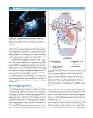 804      CHAPTER 39             Cardiac Diseases

                                                                                                          Head and
                                                                                                       upper extremities



                                    AO                                                    SVC
                                                                                                                               Aorta
                                                                                                          PA
                                                                                                                                    PA

                                                                             Right
                     PA                                                       lung                  PV                                              Left
                                                                                                                                                    lung


                                                                                                                          LA        PV
                                                                                                                PA


                                                                                                  RA
                                                                                                                               LV
FIGURE 39-3 Transesophageal echocardiographic image of a                                                                                      Descending
patent ductus arteriosus. A communication is present between the                                                                              aorta
                                                                                                                     RV
proximal portion of the descending aorta (AO) and the pulmonary
artery (PA). Color imaging (arrow) conﬁrms blood ﬂow from the aorta
into the PA.                                                                           IVC


cular catheter.34 If a patient does become pregnant before PDA occlu-
sion, an uncomplicated left-to-right shunt can be managed safely.
Endocarditis is a risk in patients with PDA, and antibiotic prophylaxis
is required. Embolic complications of infective endocarditis and end-
arteritis secondary to PDA may take the form of infected pulmonary
emboli. The patient becomes febrile with respiratory symptoms, and
the chest radiograph shows multiple opacities and inﬁltrates.                                                     Trunk and
                                                                                                               lower extremities
    The leading cause of Eisenmenger syndrome is a large VSD, fol-
lowed in prevalence by a large PDA. As with VSD, individuals with PDA                 Arterial blood                                Venous and arterial
may sustain severe increases in pulmonary vascular resistance with the                (fully saturated)                             blood
corresponding pulmonary hypertension and right ventricular hyper-                                                                   Cyanosis visible
trophy, yet fall short of Eisenmenger physiology. The maternal risk
                                                                                      Small admixture of                            Venous blood
during pregnancy is high in this situation, similar to that encountered               venous blood
in VSD with equivalent pathology. Treatment is the same as in VSD                     No visible cyanosis
with Eisenmenger syndrome. When the pulmonary pressure rises, the
aortopulmonary shunt decreases, and the murmur becomes progres-             FIGURE 39-4 Eisenmenger complex. Here the cause of right-to-left
sively quieter and shorter, until it ﬁnally disappears.                     shunt across the ventricular septal defect is increased pulmonary
    In general, the woman with uncomplicated PDA tolerates preg-            vascular resistance arising in the small pulmonary arteries and
nancy well. If pulmonary hypertension supervenes, the risk to the           arterioles. IVC, inferior vena cava; LA, left atrium; LV, left ventricle;
                                                                            PA, pulmonary artery; PV, pulmonary vein; RA, right atrium; RV, right
mother becomes signiﬁcant. Therefore, if pulmonary hypertension is
                                                                            ventricle; SVC, superior vena cava. (Reprinted by permission of the
suspected and documented, termination of pregnancy is strongly              publisher. From Taussig HB: Congenital Malformations of the Heart.
recommended.                                                                Cambridge, Mass, Harvard University Press, 1960. Copyright © 1960
                                                                            by the Commonwealth Fund by the President and Fellows of Harvard
                                                                            College.)
Eisenmenger Syndrome
Eisenmenger syndrome is characterized by a congenital communica-
tion between the systemic and pulmonary circulations and increased          ventricles. It is more common in girls and develops at a young age.
pulmonary vascular resistance, either to systemic level (so that there is   Therefore, when increased pulmonary vascular resistance is detected
no shunt across the defect) or exceeding systemic (allowing right-to-       in a child with a large VSD, operative closure must be done as soon as
left shunting). As mentioned, the most common underlying defect is          possible to prevent the development of Eisenmenger pathophysiology.
a large VSD, followed in prevalence by a large PDA. Eisenmenger             Once this has appeared, pulmonary hypertension is irreversible, and
pathophysiology is less common in ASD. Occasionally, this type of           the VSD is consequently inoperable (unless lung transplantation is
pathophysiology develops in other, less common defects. By the time         performed as well).
the syndrome is fully developed, it is often difﬁcult clinically to diag-       The major clues that pulmonary vascular resistance is increasing
nose the underlying defect. For this discussion, the VSD serves as a        are (1) diminution of evidence of a left-to-right shunt and (2) the
good model (Fig. 39-4).                                                     appearance of progressively severe pulmonary hypertension. The pan-
    Eisenmenger pathophysiology develops only if the defect is large        systolic murmur of VSD or the continuous murmur of PDA is replaced
and is not restrictive, resulting in equal systolic pressure in the two     by a short ejection systolic murmur. The lungs are no longer plethoric
 