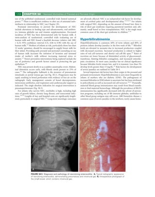 1208     CHAPTER 58             Neonatal Morbidities of Prenatal and Perinatal Origin

size of the published randomized, controlled trials limited statistical     are adversely affected. NEC is an independent risk factor for develop-
power.125 There is insufﬁcient evidence to alter use of antenatal indo-     ment of cerebral palsy and developmental delay.129,130,132 For infants
methacin in relationship to NEC (see Chapter 29).                           with surgical NEC, depending on the amount of bowel lost, there is
    Postnatal interventions to prevent the development of NEC               risk of short gut syndrome requiring parenteral nutrition and, ulti-
include alterations in feeding type and advancements, oral antibiot-        mately, small bowel or liver transplantation. NEC is the single most
ics, immune globulin use and vitamin supplementation. Decreased             common cause of the short gut syndrome in children.27-29
incidence of NEC has been demonstrated only for human milk. A
meta-analysis of randomized, controlled trials evaluating use of
human milk and NEC found a fourfold decrease (relative risk [RR]            Hyperbilirubinemia
= 0.25; 95% conﬁdence interval [CI], 0.06 to 0.98) with the use of          Hyperbilirubinemia is common; 60% of term infants and 80% of
human milk.126 Mothers of infants at risk, particularly those less than     preterm infants develop jaundice in the ﬁrst week of life.133 Bilirubin
32 weeks’ gestation, should be encouraged to supply breast milk for         levels are elevated in neonates due to increased production coupled
their infant. Providing early prenatal and postnatal counseling on use      with decreased excretion. Increased production is related to higher
of human milk increases the initiation of lactation and neonatal            rates of red cell turnover and shorter red cell life span.134 Rates of
intake of mother’s milk without increasing maternal stress or               excretion are lower because of diminished activity of glucoronosyl-
anxiety.127 Newer preventive interventions being explored include the       transferase, limiting bilirubin conjugation, and increased enterohe-
use of probiotics and growth factors aimed at protecting the gut            patic circulation. In most cases, jaundice has no clinical signiﬁcance
epithelium.128                                                              because bilirubin levels remain low, and it is transient. Less than 3%
    NEC may present slowly or as a sudden catastrophic event. Abdom-        develop levels greater than 15 mg/dL.133 Risk factors for development
inal distention occurs early, with bloody stools present in 25% of          of severe jaundice are outlined in Table 58-5.
cases.110 The radiographic hallmark is the presence of pneumatosis              Several important risk factors have their origin in the prenatal and
intestinalis or portal venous gas (see Fig. 58-2). Progression may be       perinatal environment. Hyperbilirubinemia is seen more frequently in
rapid, resulting in bowel perforation with evidence of free air on the      infants of mothers who are diabetic (IDM). The pathogenesis of
radiograph. Early management consists of bowel decompression,               increased bilirubin in IDM infants is uncertain but has been attributed
intravenous antibiotics, and respiratory and cardiovascular support as      to polycythemia as well as increased red cell turnover.136,137 Prenatally,
indicated. The single absolute indication for surgical intervention is      maternal blood group immunization may result from blood transfu-
pneumoperitoneum (Fig. 58-5).                                               sion or fetal maternal hemorrhage. Although the prevalence of Rh(D)
    For infants who survive NEC, morbidity is high, including high          immunization has signiﬁcantly decreased with the advent of preven-
rates of growth failure, chronic lung disease, and nosocomial infec-        tion programs, including use of Rh immune globulin, antibodies to
tions.129-131 Lengths of stay and hospital costs are signiﬁcantly length-   other blood group antigens may still occur. ABO hemolytic disease, a
ened, particularly in surgical NEC.131 Long-term neurologic outcomes        common cause of severe jaundice in the newborn, rarely causes hemo-




                    A                                                       B
                   FIGURE 58-5 Diagnosis and pathology of necrotizing enterocolitis. A, Typical radiographic appearance
                   of necrotizing enterocolitis, demonstrating pneumatosis and intramural gas. B, Intraoperative photograph of
                   the small bowel, which contains intramural gas.
 