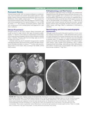 CHAPTER 58            Neonatal Morbidities of Prenatal and Perinatal Origin            1213
                                                                             Pathophysiology and Risk Factors
Perinatal Stroke                                                             The mechanisms of perinatal stroke are thought to be multifactorial.
Arterial ischemic stroke (AIS) in neonates is deﬁned as a cerebrovas-        Regional ischemia with subsequent hypoxia and infarction plays a role.
cular event around the time of birth with resultant clinical or radio-       A relative hypercoagulable state in newborns due to the presence of
graphic evidence of focal cerebral arterial infarction. Most occur in the    fetal hemoglobin, polycythemia, and activation of coagulation factors
distribution of the middle cerebral artery.176,218-220 AIS accounts for      in the fetus and mother around the time of birth seems to increase the
most perinatal ischemic strokes. When the diagnosis is based on symp-        risk of a thromboembolic event leading to stoke.176,227 Risk factors for
toms in the neonatal period, the reported incidence is 1 case in 4000        perinatal stroke include maternal and placental disorders, neonatal
live births.176,221,222 The incidence of perinatal ischemic strokes that     hypoxic-ischemic injury, hematologic disorders, infection, cardiac dis-
were asymptomatic in the neonatal period and diagnosed at a later            orders, trauma, and drugs. Often, a combination of risk factors is
time is unknown.                                                             identiﬁed.

Clinical Presentation                                                        Neuroimaging and Electroencephalographic
Neonatal seizures are the most common clinical presentation and              Assessment
usually are focal in origin without other signs of neonatal encepha-         Although cranial ultrasound is the easiest to perform, it is not a sensi-
lopathy.176,223 However, some infants are systemically ill, and the diag-    tive indicator of perinatal stroke.175 Little information exists on prena-
nosis is made with neuroimaging to rule out evidence of hypoxic-ischemic     tal cranial ultrasound, but prenatal ultrasound scans may show areas
injury or bleeding. Neonates with focal neurologic signs account for         of unilateral echolucencies, which may represent areas later identiﬁed
less than 25% of cases.218,222,224,225                                       as prenatal stroke. CT imaging can usually be performed readily in
    Perinatal stroke may also be identiﬁed retrospectively in initially      neonates and usually does not require sedation. CT evidence of peri-
well-appearing infants who present in later months with signs of hemi-       natal ischemic stroke includes focal hypodensity with or without
paresis, developmental delay, or seizures.176,226 In these cases, neuroim-   intraparenchymal hemorrhage, abnormal gray-white differentiation,
aging reveals a remote injury, often occurring in the middle cerebral        and evidence of volume loss or porencephaly if the injury is remote
artery territory.                                                            from the time of delivery176 (Fig. 58-6).




    A                                                                        B
  FIGURE 58-6 Diagnostic imaging studies of neonatal stroke. A, Magnetic resonance imaging study of a 6-month-old infant
  demonstrates a large region of encephalomalacia involving most of the left temporal lobe and large regions of the left frontal and parietal
  lobes. The distribution is consistent with a remote infarction of the left middle cerebral artery. The infant had a history of sepsis and
  disseminated intravascular coagulation during the early neonatal period. An ultrasound scan when the infant was 1 day old was
  unremarkable. B, Computed tomography of a 1-day-old term infant who presented with a focal seizure. The perinatal history was
  unremarkable. There is loss of gray-white matter differentiation involving the right parietal and occipital regions (arrow). There is a smaller
  area of involvement in the right frontal region. A cranial ultrasound examination was normal.
 
