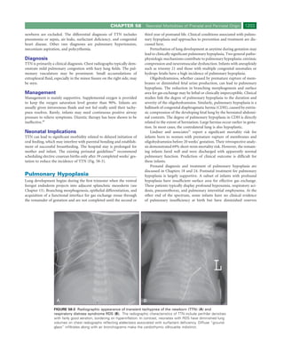 CHAPTER 58          Neonatal Morbidities of Prenatal and Perinatal Origin             1203
newborn are excluded. The differential diagnosis of TTN includes           third year of postnatal life. Clinical conditions associated with pulmo-
pneumonia or sepsis, air leaks, surfactant deﬁciency, and congenital       nary hypoplasia and approaches to prevention and treatment are dis-
heart disease. Other rare diagnoses are pulmonary hypertension,            cussed here.
meconium aspiration, and polycythemia.                                         Perturbation of lung development at anytime during gestation may
                                                                           lead to clinically signiﬁcant pulmonary hypoplasia. Two general patho-
Diagnosis                                                                  physiologic mechanisms contribute to pulmonary hypoplasia: extrinsic
TTN is primarily a clinical diagnosis. Chest radiographs typically dem-    compression and neuromuscular dysfunction. Infants with aneuploidy
onstrate mild pulmonary congestion with hazy lung ﬁelds. The pul-          such as trisomy 21 and those with multiple congenital anomalies or
monary vasculature may be prominent. Small accumulations of                hydrops fetalis have a high incidence of pulmonary hypoplasia.
extrapleural ﬂuid, especially in the minor ﬁssure on the right side, may       Oligohydramnios, whether caused by premature rupture of mem-
be seen.                                                                   branes or diminished fetal urine production, can lead to pulmonary
                                                                           hypoplasia. The reduction in branching morphogenesis and surface
Management                                                                 area for gas exchange may be lethal or clinically imperceptible. Clinical
Management is mainly supportive. Supplemental oxygen is provided           studies link the degree of pulmonary hypoplasia to the duration and
to keep the oxygen saturation level greater than 90%. Infants are          severity of the oligohydramnios. Similarly, pulmonary hypoplasia is a
usually given intravenous ﬂuids and not fed orally until their tachy-      hallmark of congenital diaphragmatic hernia (CDH), caused by extrin-
pnea resolves. Rarely, infants may need continuous positive airway         sic compression of the developing fetal lung by the herniated abdomi-
pressure to relieve symptoms. Diuretic therapy has been shown to be        nal contents. The degree of pulmonary hypoplasia in CDH is directly
ineffective.49                                                             related to the extent of herniation. Large hernias occur earlier in gesta-
                                                                           tion. In most cases, the contralateral lung is also hypoplastic.
Neonatal Implications                                                          Lindner and associates51 report a signiﬁcant mortality risk for
TTN can lead to signiﬁcant morbidity related to delayed initiation of      infants born to women with premature rupture of membranes and
oral feeding, which may interfere with parental bonding and establish-     oligohydramnios before 20 weeks’ gestation. Their retrospective analy-
ment of successful breastfeeding. The hospital stay is prolonged for       sis demonstrated 69% short-term mortality risk. However, the remain-
mother and infant. The existing perinatal guidelines50 recommend           ing infants fared well and were discharged with apparently normal
scheduling elective cesarean births only after 39 completed weeks’ ges-    pulmonary function. Prediction of clinical outcome is difﬁcult for
tation to reduce the incidence of TTN (Fig. 58-3).                         these infants.
                                                                               Prenatal diagnosis and treatment of pulmonary hypoplasia are
                                                                           discussed in Chapters 18 and 24. Postnatal treatment for pulmonary
Pulmonary Hypoplasia                                                       hypoplasia is largely supportive. A subset of infants with profound
Lung development begins during the ﬁrst trimester when the ventral         hypoplasia have insufﬁcient surface area for effective gas exchange.
foregut endoderm projects into adjacent splanchnic mesoderm (see           These patients typically display profound hypoxemia, respiratory aci-
Chapter 15). Branching morphogenesis, epithelial differentiation, and      dosis, pneumothorax, and pulmonary interstitial emphysema. At the
acquisition of a functional interface for gas exchange ensue through       other end of the spectrum, some infants have no clinical evidence
the remainder of gestation and are not completed until the second or       of pulmonary insufﬁciency at birth but have diminished reserves




                    A                                                      B
                  FIGURE 58-3 Radiographic appearance of transient tachypnea of the newborn (TTN) (A) and
                  respiratory distress syndrome RDS (B). The radiographic characteristics of TTN include perihilar densities
                  with fairly good aeration, bordering on hyperinﬂation. In contrast, neonates with RDS have diminished lung
                  volumes on chest radiographs reﬂecting atelectasis associated with surfactant deﬁciency. Diffuse “ground-
                  glass” inﬁltrates along with air bronchograms make the cardiothymic silhouette indistinct.
 