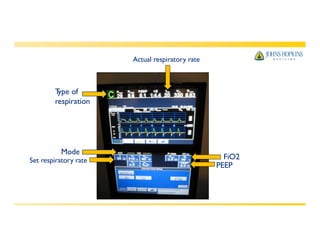 T
ype of
respiration
Mode
Set respiratory rate
Actual respiratory rate
FiO2
PEEP
 