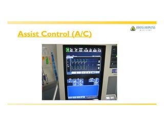 Assist Control (A/C)
 