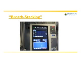 “Breath-Stacking”
 