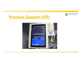 Pressure Support (PS)
 
