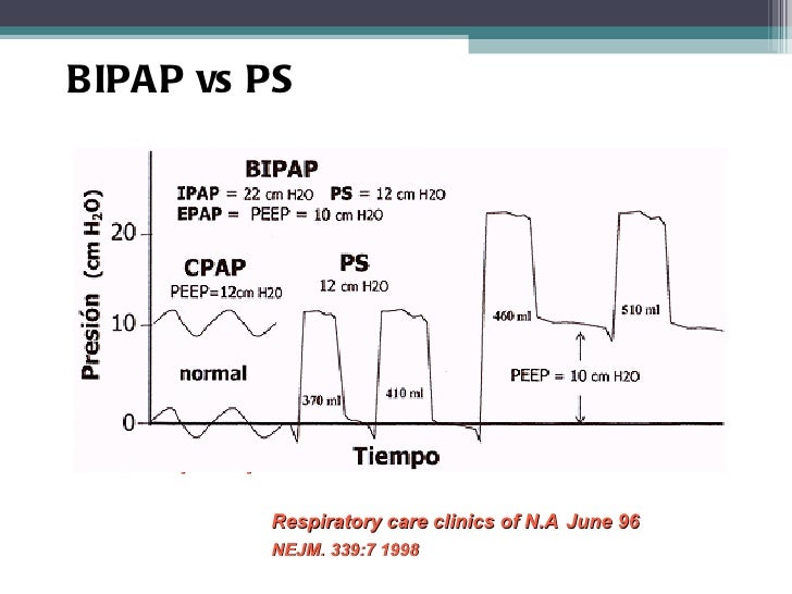 ipapとは, epap 人工呼吸器 – PKLE