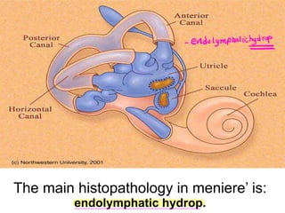 The main histopathology in meniere’ is:
endolymphatic hydrop.
eddolymphatic
hydrop
 