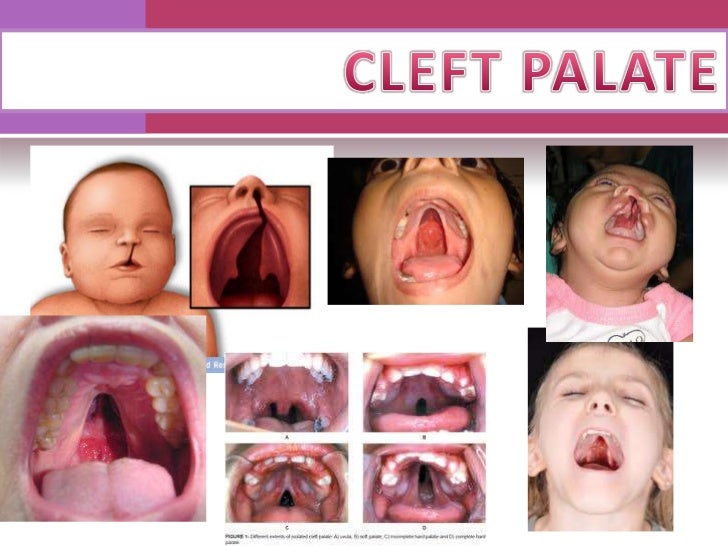 4. virola cleft palate