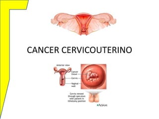 CANCER CERVICOUTERINO

 