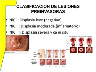 CLASIFICACION DE LESIONES
PREINVASORAS
• NIC I: Displasia leve.(negativo)
• NIC II: Displasia moderada.(inflamatorio)
• NIC III: Displasia severa y ca in situ.

 
