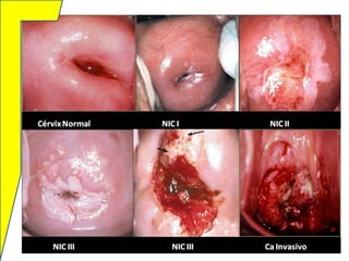 40. Cáncer Cervicouterino (31-Oct-2013)