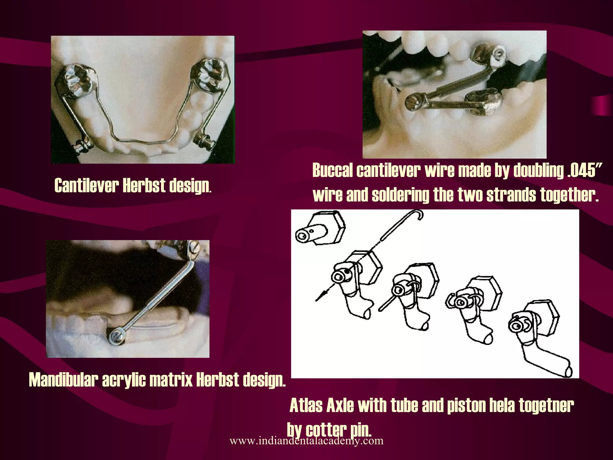Cantilever Herbst design.
Buccal cantilever wire made by doubling .045"
wire and soldering the two strands together.
Mandibular acrylic matrix Herbst design.
Atlas Axle with tube and piston hela togetner
by cotter pin.www.indiandentalacademy.com
 