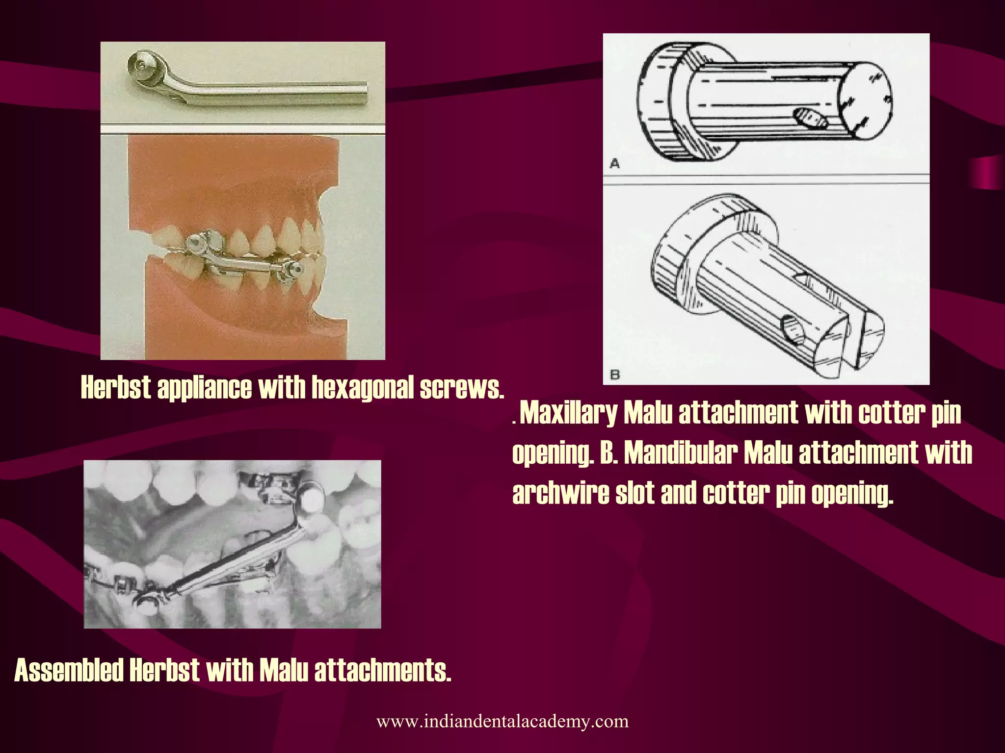 Herbst appliance with hexagonal screws.
. Maxillary Malu attachment with cotter pin
opening. B. Mandibular Malu attachment with
archwire slot and cotter pin opening.
Assembled Herbst with Malu attachments.
www.indiandentalacademy.com
 