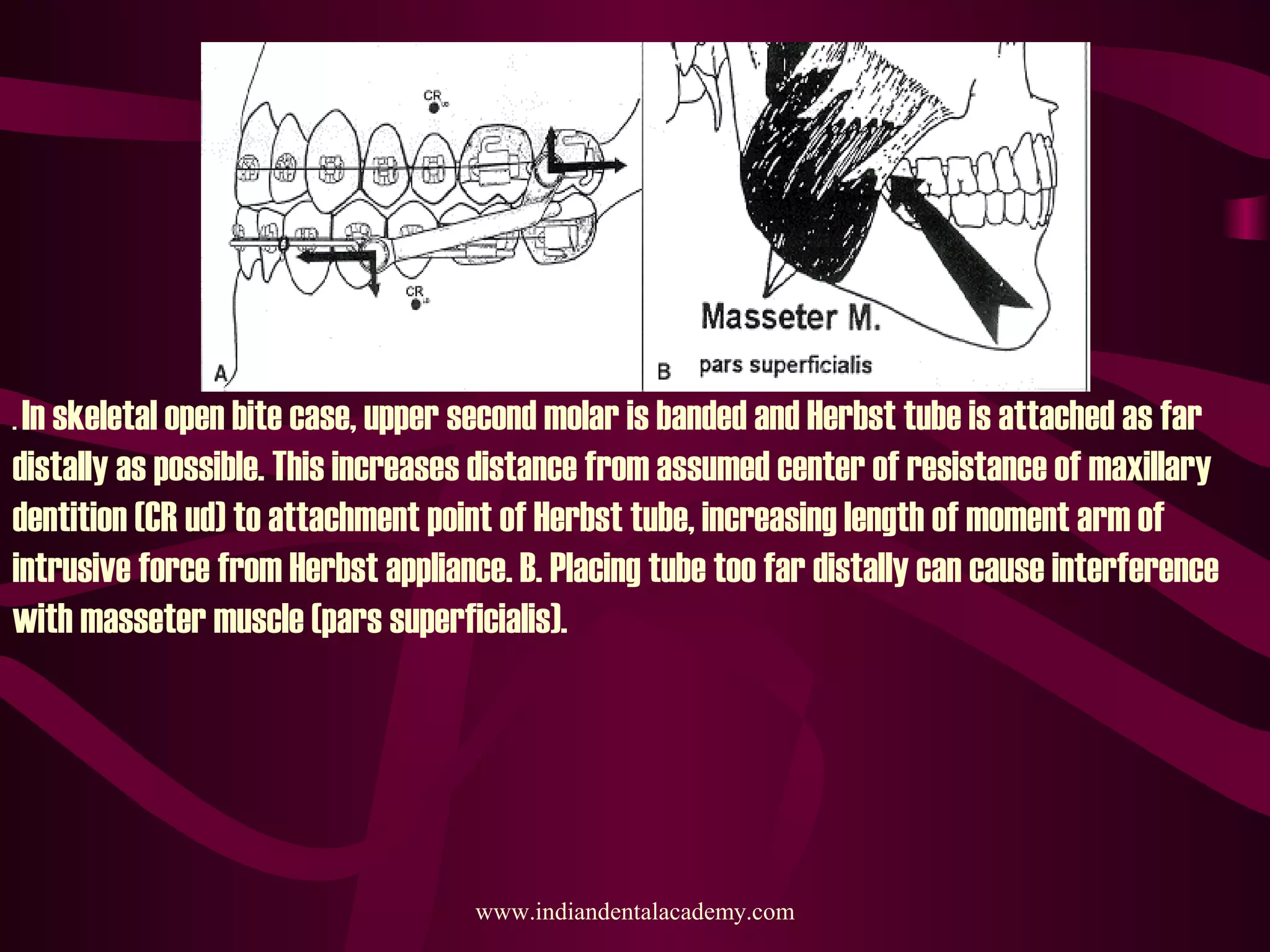 . In skeletal open bite case, upper second molar is banded and Herbst tube is attached as far
distally as possible. This increases distance from assumed center of resistance of maxillary
dentition (CR ud) to attachment point of Herbst tube, increasing length of moment arm of
intrusive force from Herbst appliance. B. Placing tube too far distally can cause interference
with masseter muscle (pars superficialis).
www.indiandentalacademy.com
 