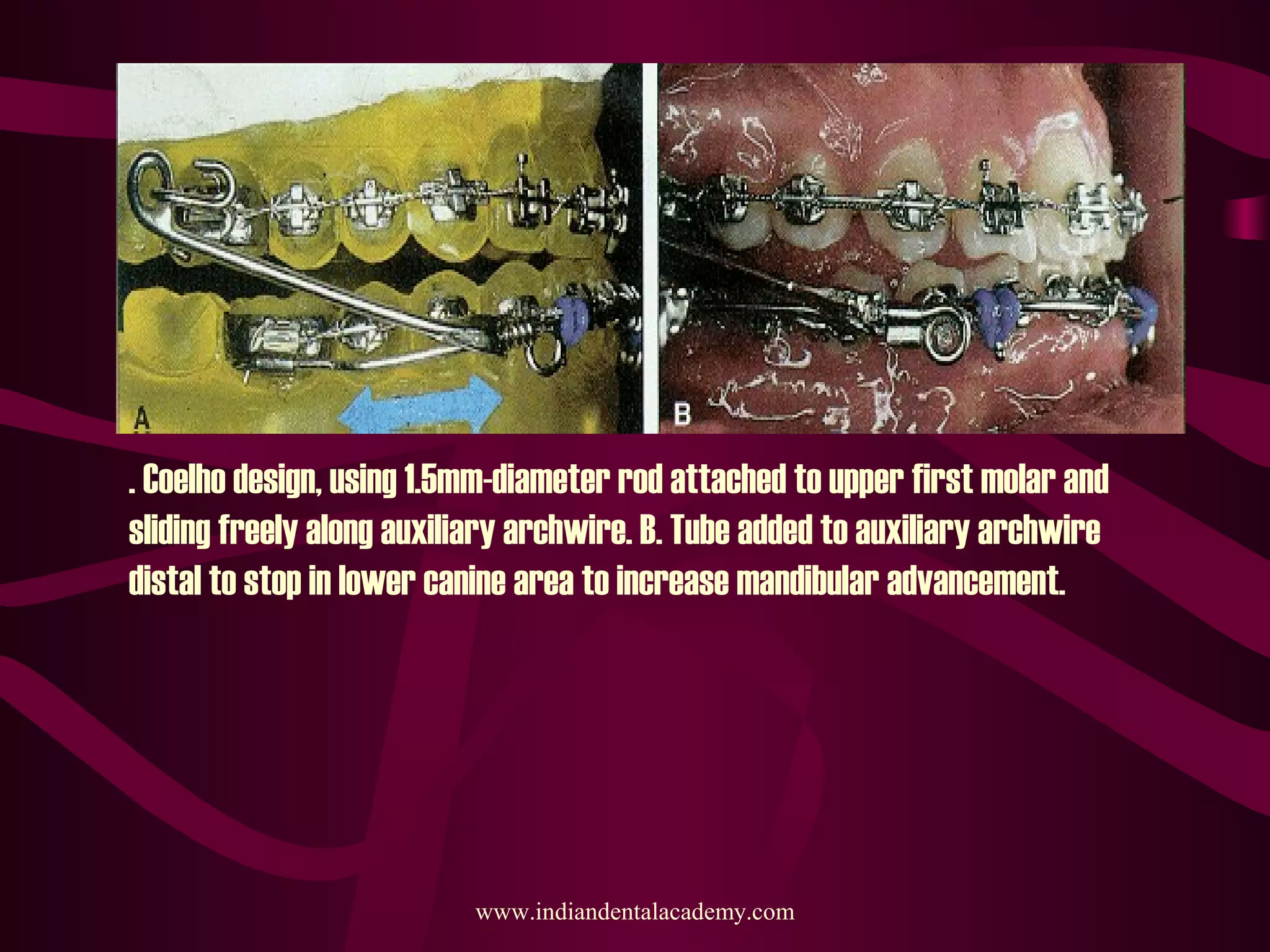. Coelho design, using 1.5mm-diameter rod attached to upper first molar and
sliding freely along auxiliary archwire. B. Tube added to auxiliary archwire
distal to stop in lower canine area to increase mandibular advancement.
www.indiandentalacademy.com
 