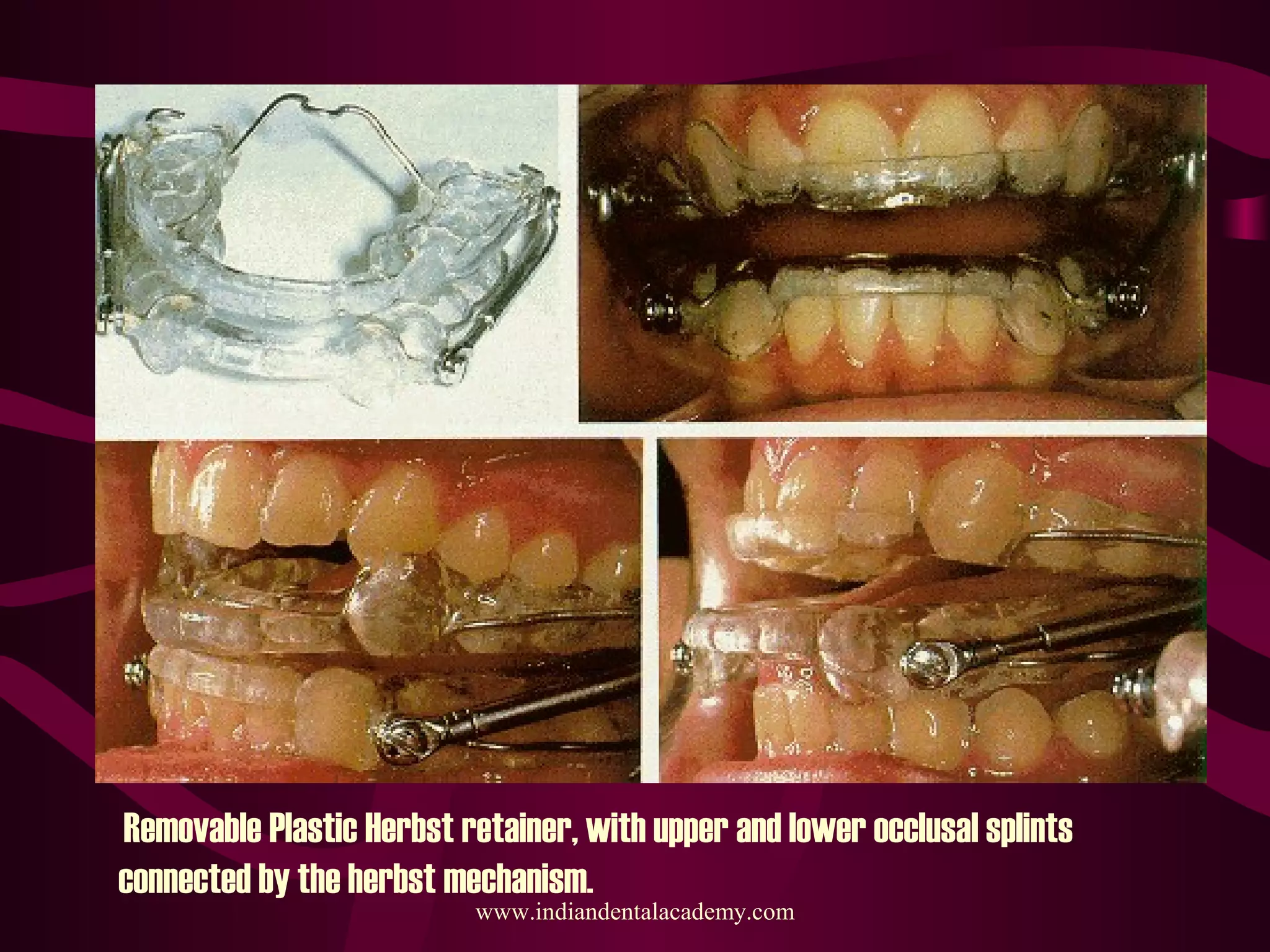 Removable Plastic Herbst retainer, with upper and lower occlusal splints
connected by the herbst mechanism.
www.indiandentalacademy.com
 