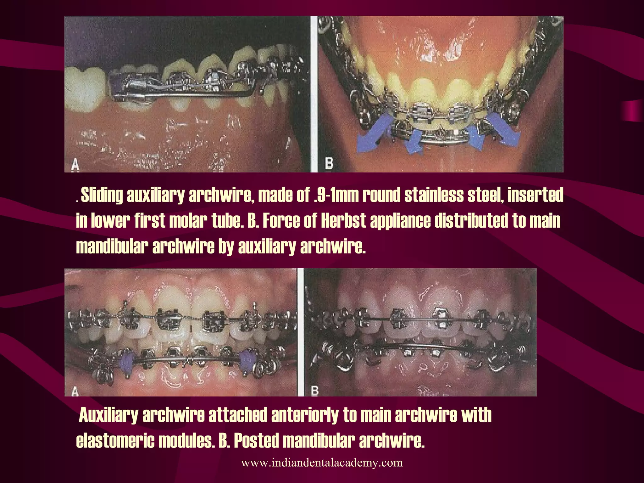 Herbst appliance & its modifications