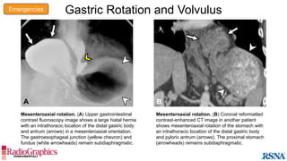 Stomach Rotation Radiology CA de estómago | PPTX