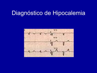 Diagnóstico de Hipocalemia 
