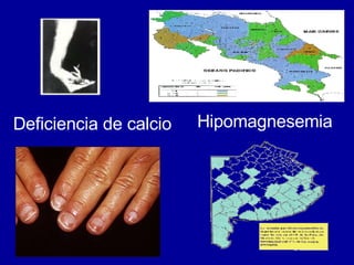 Hipomagnesemia Deficiencia de calcio 