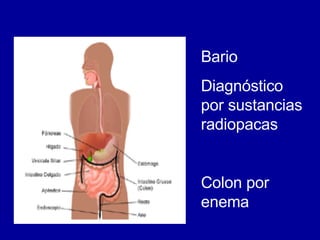 Bario Diagnóstico por sustancias radiopacas Colon por enema 