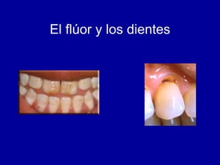 El flúor y los dientes 