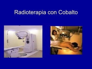 Radioterapia con Cobalto 