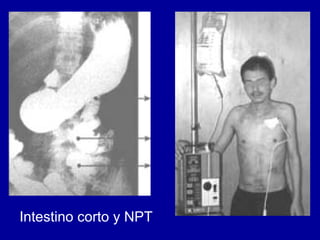 Intestino corto y NPT 