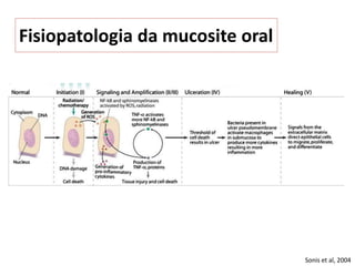 Fisiopatologia da mucosite oral
Sonis et al, 2004
 