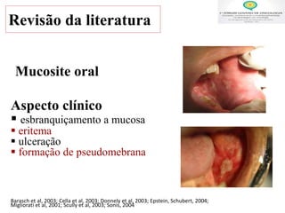 Revisão da literatura
Aspecto clínico
 esbranquiçamento a mucosa
 eritema
 ulceração
 formação de pseudomebrana
Barasch et al, 2003; Cella et al, 2003; Donnely et al, 2003; Epstein, Schubert, 2004;
Migliorati et al, 2001; Scully et al, 2003; Sonis, 2004
Mucosite oral
 