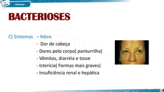 BACTERIOSES
C) Sintomas – febre.
- Dor de cabeça
- Dores pelo corpo( panturrilha)
- Vômitos, diarréia e tosse
- Icterícia( Formas mais graves)
- Insuficiência renal e hepática
19
 
