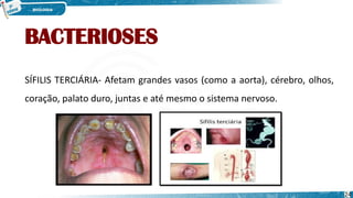 BACTERIOSES
SÍFILIS TERCIÁRIA- Afetam grandes vasos (como a aorta), cérebro, olhos,
coração, palato duro, juntas e até mesmo o sistema nervoso.
24
 