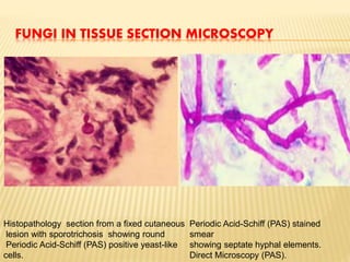 FUNGI IN TISSUE SECTION MICROSCOPY
Histopathology section from a fixed cutaneous
lesion with sporotrichosis showing round
Periodic Acid-Schiff (PAS) positive yeast-like
cells.
Periodic Acid-Schiff (PAS) stained
smear
showing septate hyphal elements.
Direct Microscopy (PAS).
 