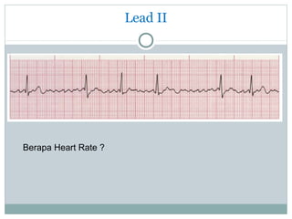 Lead II
Berapa Heart Rate ?
 
