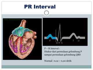 PR Interval
P – R Interval :
Diukur dari permulaan gelombang P
sampai permulaan gelombang QRS
Normal : 0,12 – 0,20 detik
 
