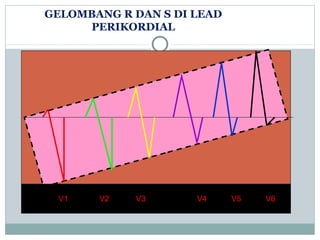 GELOMBANG R DAN S DI LEAD
PERIKORDIAL
V1 V2 V3 V4 V5 V6
 