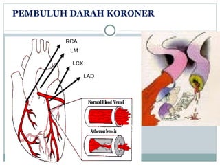 PEMBULUH DARAH KORONER
RCA
LM
LCX
LAD
 