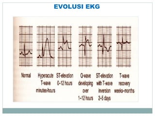 EVOLUSI EKG
 