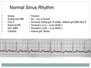 Normal Sinus Rhythm
• IramaIrama :: TeraturTeratur
• Frekwensi HRFrekwensi HR :: 60 -60 - 100 x/menit100 x/menit
• Gel. PGel. P :: Normal, setiap gel.Normal, setiap gel. PP selaluselalu diikuti gel QRS dan Tdiikuti gel QRS dan T
• Interval PRInterval PR :: Normal ( 0,12 – 0,20 detik )Normal ( 0,12 – 0,20 detik )
• Gel. QRSGel. QRS :: Normal ( 0,06 – 0,12 detik )Normal ( 0,06 – 0,12 detik )
• CatatanCatatan :: semua gel. Samasemua gel. Sama
 